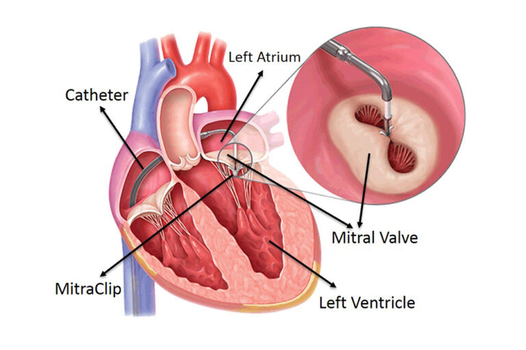 Heart Bypass Surgery (CABG) Cost in India