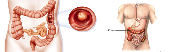 Colon cancer Treatment cost in india