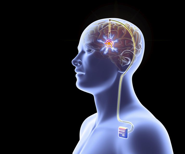 Deep Brain Stimulation surgery In India