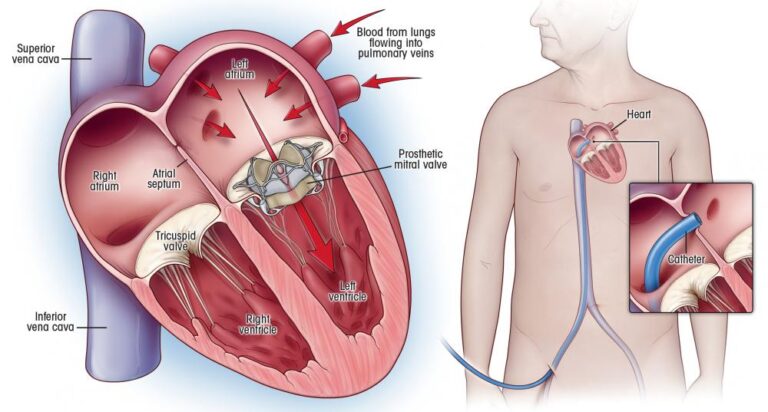 Heart Valve Replacement Surgery in India