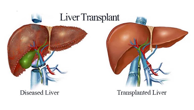 Liver Transplant Cost In India