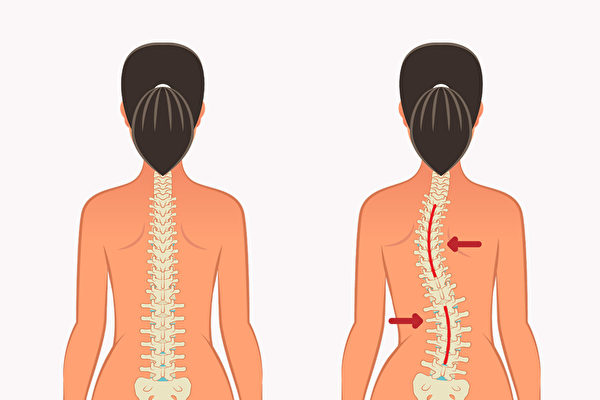 Scoliosis Surgery cost in India
