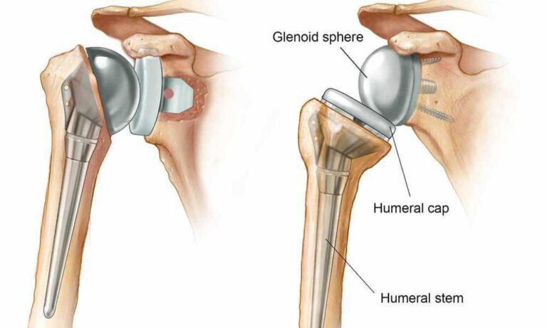 Shoulder Replacement Surgery Cost in India