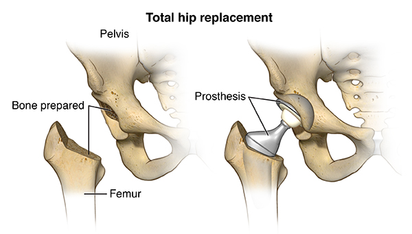 Hip Replacement Cost in India