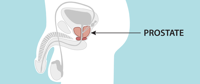 Prostate Cancer Treatment Cost In India