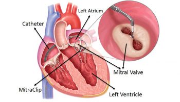 Heart Bypass Surgery (CABG) Cost in India