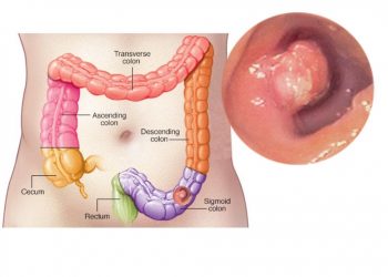 Colon cancer Treatment