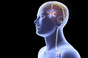Deep Brain Stimulation surgery In India