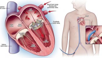Heart Valve Replacement Surgery in India