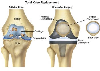 Knee replacement cost in India