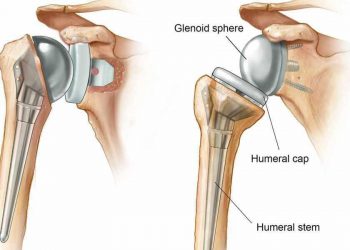 Shoulder Replacement Surgery Cost in India