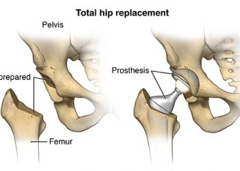 Hip Replacement Cost in India